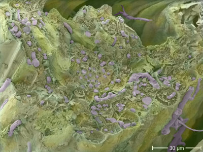 A picture of Microdochium (Fusarium) Patch active in a turf leaf